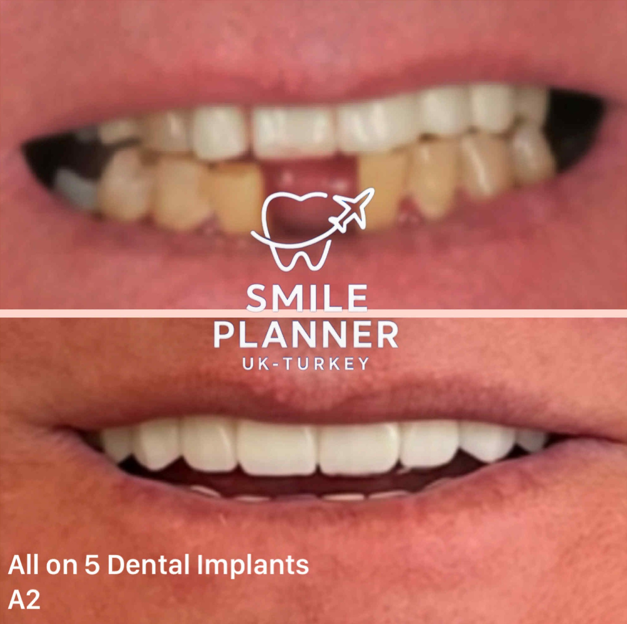 smile transformation all-on-5